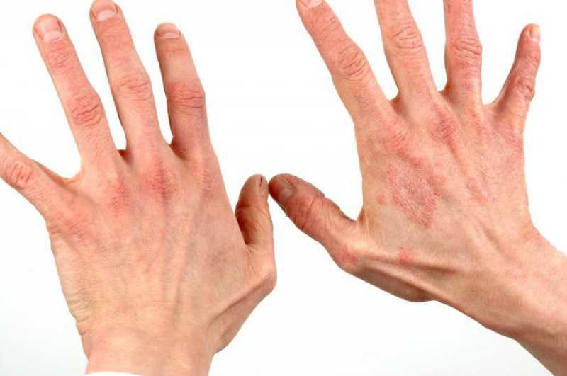 Лечение дерматита на руках