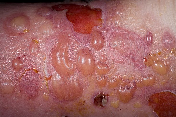 Осложнения при буллезном дерматите