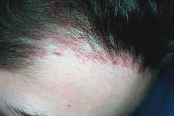 Аллергический дерматит на голове