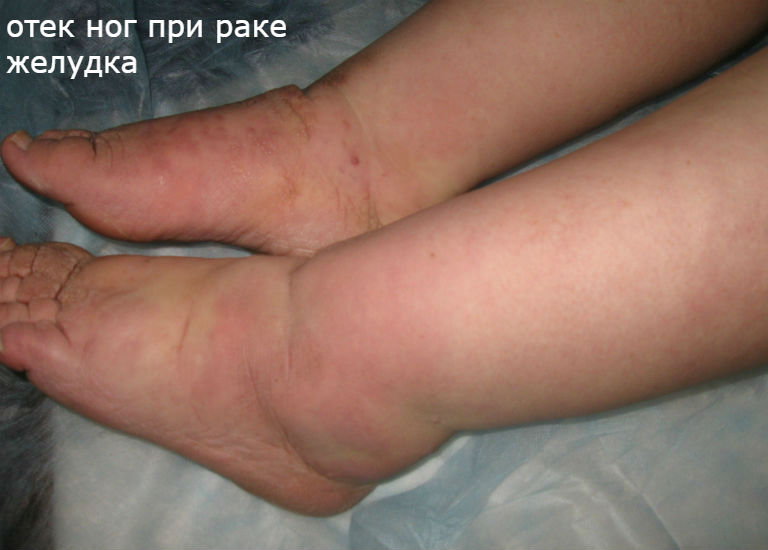 отек ног при раке желудка 4 стадии фото
