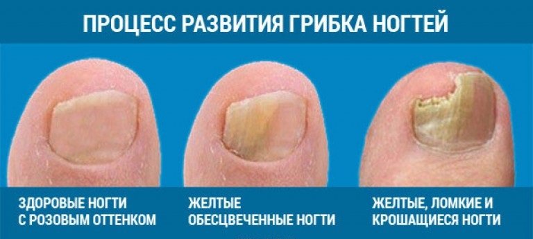 Чем лечить грибок ногтей на ногах в запущенной стадии