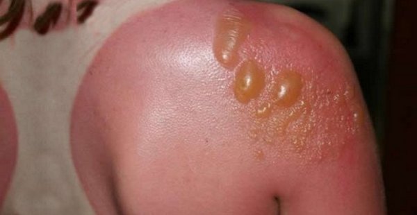Причины возникновения буллезного дерматита