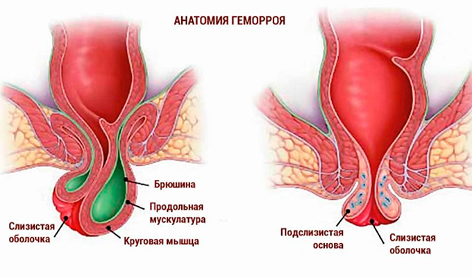 Геморрой после родов: при грудном вскармливании.